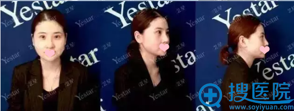隆鼻术后12天的样子,很满意 隆鼻术后12天的样子,很满意