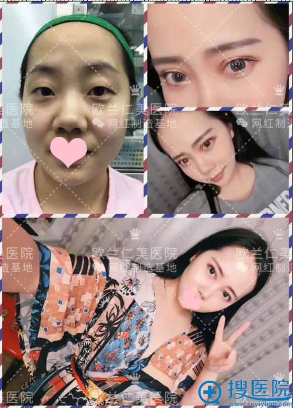 双眼皮术前术后对比 双眼皮术前术后对比