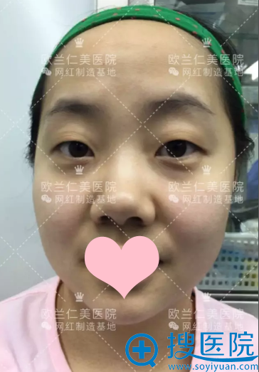 单眼皮的我找哈尔滨欧兰仁美医院王滨福医生实现了双眼皮梦想
