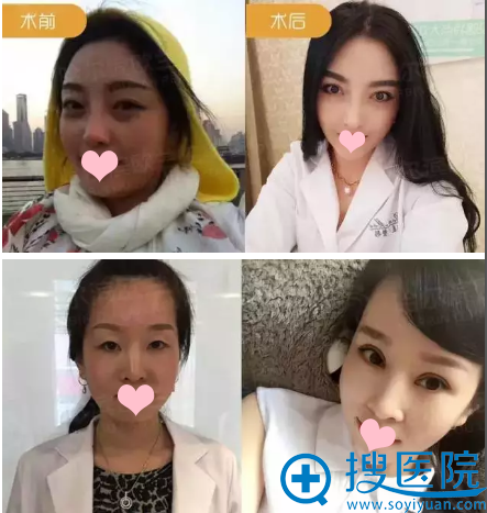 <!--<i data=20240710 data-id=12341></i>-->双眼皮案例 <!--<i data=20240710 data-id=12341></i>-->双眼皮案例