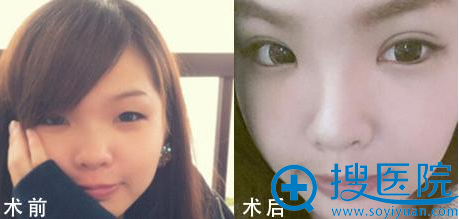 唐山金荣医院常秀芬双眼皮案例 唐山金荣医院常秀芬双眼皮案例