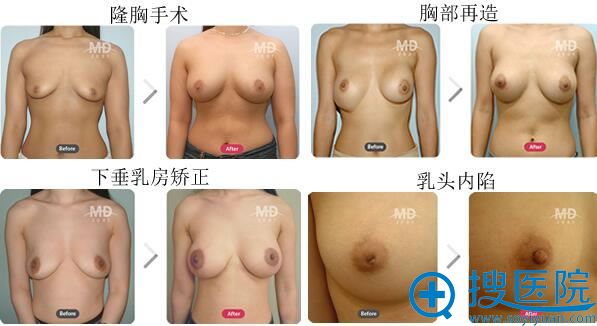 韩国md和migo哪家整形医院隆胸效果好?真实案例对比见分晓