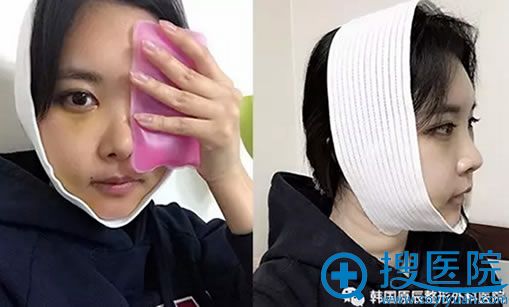 韩国原辰做面部轮廓术后第三天恢复照 韩国原辰做面部轮廓术后第三天恢复照