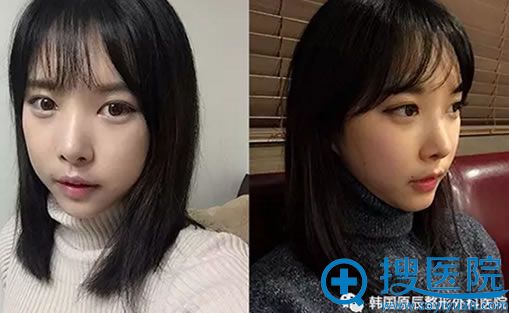 韩国整容术后14天恢复效果 韩国整容术后14天恢复效果