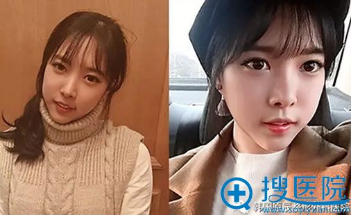 在韩国元辰做面部轮廓术后30天照片 在韩国元辰做面部轮廓术后30天照片