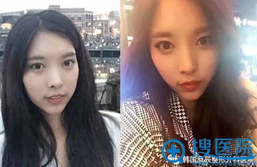 在韩国元辰整形医院做面部轮廓前后对比照 在韩国元辰整形医院做面部轮廓前后对比照