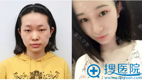 寒假找重庆华美张国强做完达芬奇双眼皮和隆鼻7天就恢复自然了