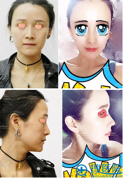 上海喜美鼻综合联合自体脂肪填充案例 看大妈如何逆龄变少女