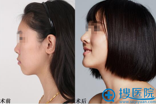 鼻部整形前后对比图 鼻部整形前后对比图