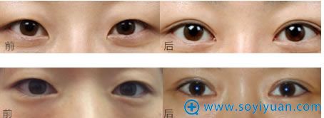 双眼皮案例图_<!--<i data=20240710 data-id=9828></i>--> 双眼皮案例图_<!--<i data=20240710 data-id=9828></i>-->