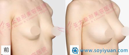 隆胸案例图_<!--<i data=20240710 data-id=9828></i>-->整形 隆胸案例图_<!--<i data=20240710 data-id=9828></i>-->整形