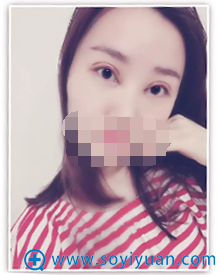 双眼皮术后2天依然红肿 双眼皮术后2天依然红肿