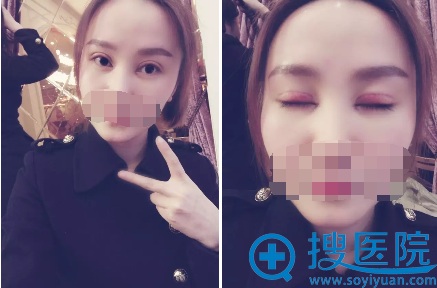 切开双眼皮术后4天恢复效果 切开双眼皮术后4天恢复效果