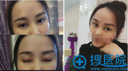 手术7天拆线后,睁眼闭眼效果 手术7天拆线后,睁眼闭眼效果