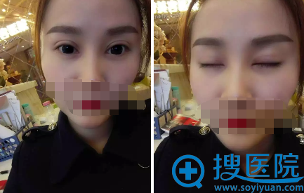 切开双眼皮术后半月睁眼闭眼效果 切开双眼皮术后半月睁眼闭眼效果