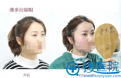 长沙华韩华美于春国切开双眼皮案例对比图 长沙华韩华美于春国切开双眼皮案例对比图
