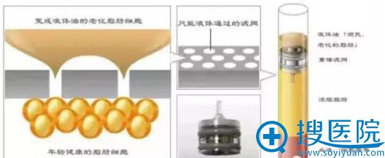 日本自体脂肪CRF重锤分离法提取 日本自体脂肪CRF重锤分离法提取