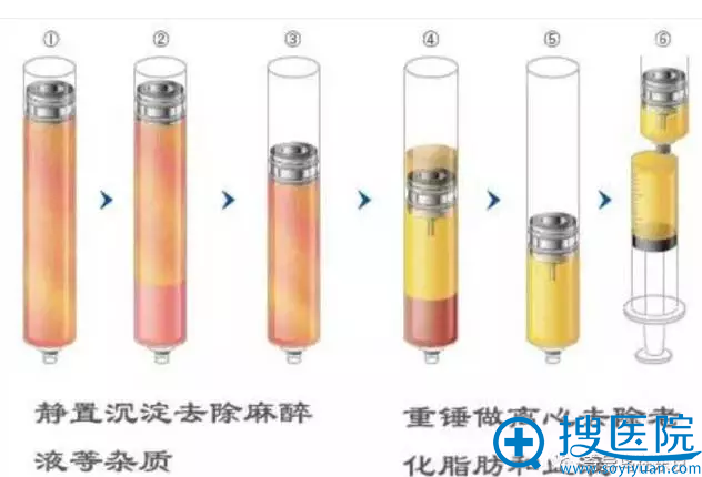 日本自体脂肪CRF重锤分离法提纯 日本自体脂肪CRF重锤分离法提纯