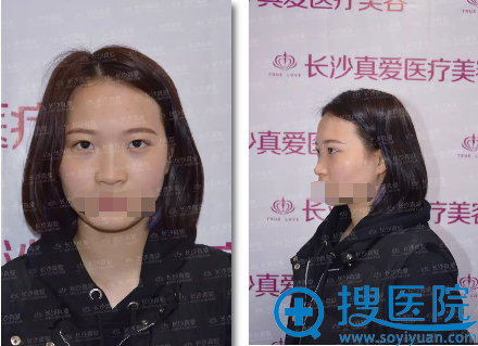 长沙真爱整形医院黄志鹏综合隆鼻案例 妈妈再也不怕我嫁不出去