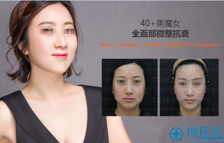 注射祛鱼尾纹+热拉提除皱+激光溶脂祛羊腮+法令纹多维提拉术 注射祛鱼尾纹+热拉提除皱+激光溶脂祛羊腮+法令纹多维提拉术