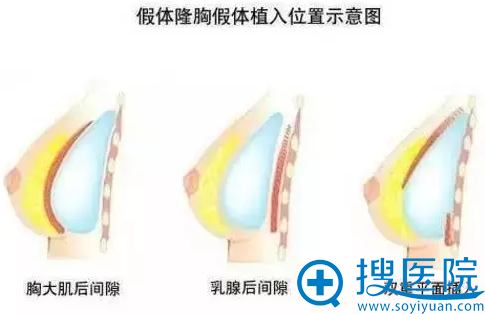 假体隆胸植入位置示意图 假体隆胸植入位置示意图