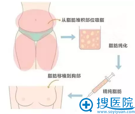 自体脂肪隆胸流程示意图 自体脂肪隆胸流程示意图