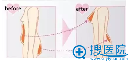 自体脂肪移植隆胸示意图 自体脂肪移植隆胸示意图