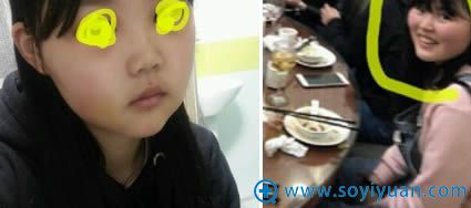 在韩国妩丽整形医院做面部轮廓术前照 在韩国妩丽整形医院做面部轮廓术前照