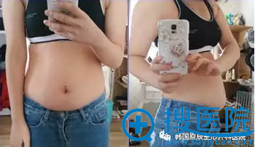 韩国原辰全身吸脂案例 多肉女孩变元气少女看我花了多少钱