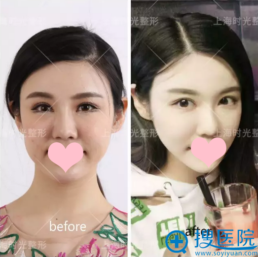 整形前后对比照 整形前后对比照