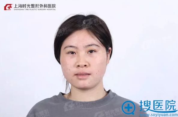 晶晶术前正面照 晶晶术前正面照