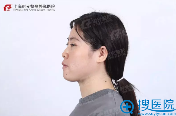 晶晶术前测面照 晶晶术前测面照