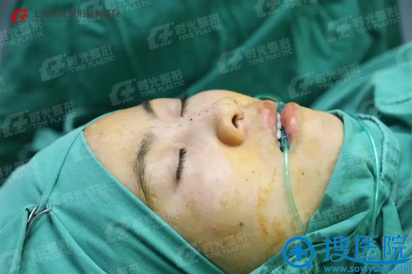 术前,鼻部画线准备完毕 术前,鼻部画线准备完毕