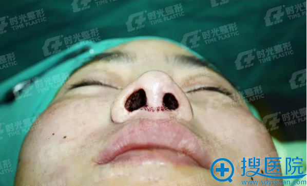 术中,鼻翼缩小术进行一半的对比照 术中,鼻翼缩小术进行一半的对比照