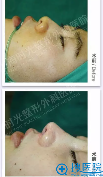 鼻综合术前术后对比照片 鼻综合术前术后对比照片