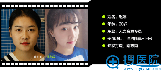 隋志甫注射隆鼻+下巴案例 隋志甫注射隆鼻+下巴案例