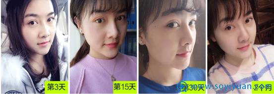 隋志甫注射隆鼻术后3-2个月恢复效果 隋志甫注射隆鼻术后3-2个月恢复效果
