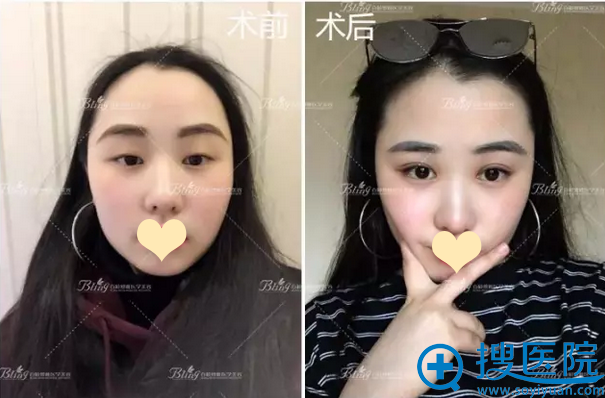 <!--<i data=20240710 data-id=12473></i>-->博雅双眼皮真人案例 <!--<i data=20240710 data-id=12473></i>-->博雅双眼皮真人案例