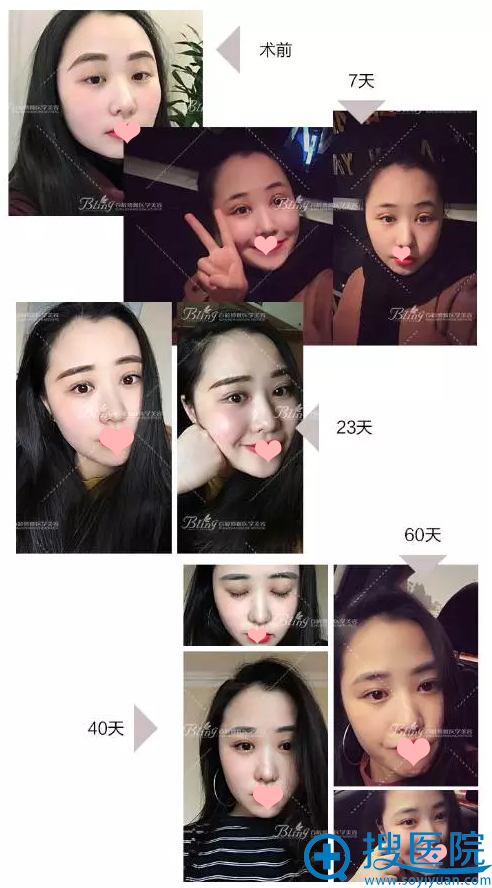 <!--<i data=20240710 data-id=12473></i>-->博雅双眼皮术后60天恢复过程图 <!--<i data=20240710 data-id=12473></i>-->博雅双眼皮术后60天恢复过程图