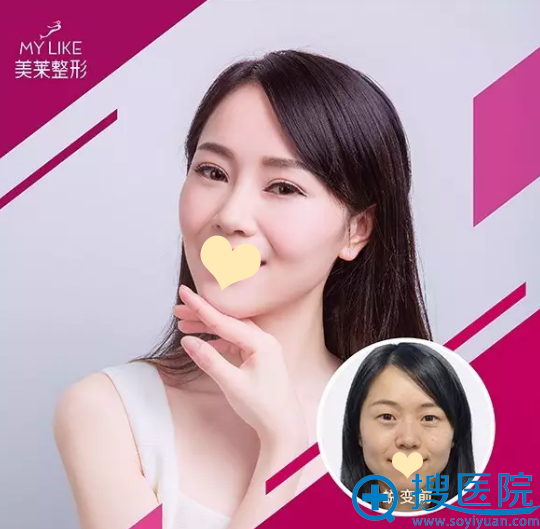 【真人案例】花5280元在宁波美莱整形医院做全切双眼皮46天了