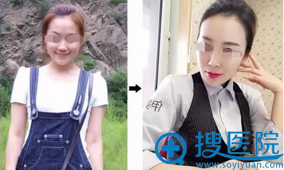 常维国自体脂肪填充额头、苹果肌案例术后对比效果 常维国自体脂肪填充额头、苹果肌案例术后对比效果