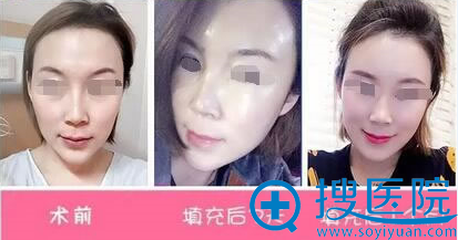 常维国自体脂肪填充术后恢复过程 常维国自体脂肪填充术后恢复过程