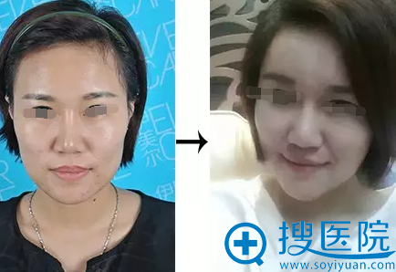 常维国自体脂肪面部填充案例效果 常维国自体脂肪面部填充案例效果