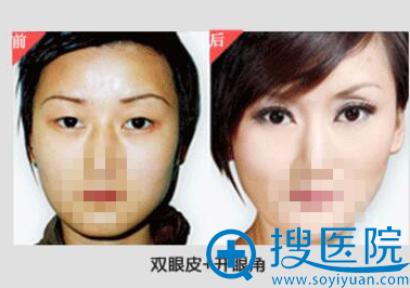 双眼皮+开眼角 双眼皮+开眼角