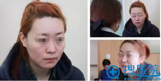 南宁东方整形医院刘刚线雕全脸提升案例 女神蜕变就这么简单