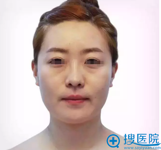术前正面照 术前正面照