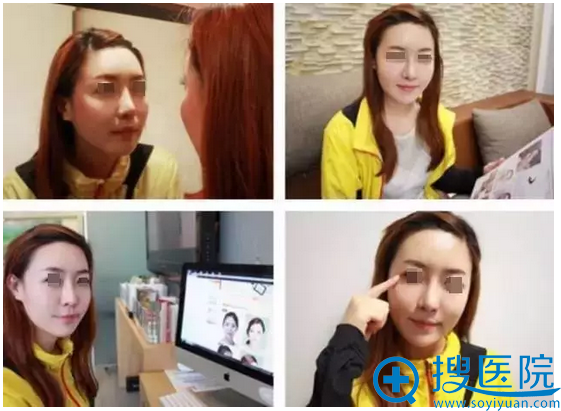 线雕后面部一天天紧致 线雕后面部一天天紧致