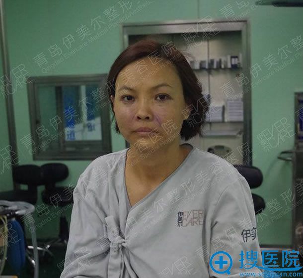 <!--<i data=20240710 data-id=12077></i>-->做外路祛眼袋效果 <!--<i data=20240710 data-id=12077></i>-->做外路祛眼袋效果