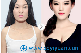 <!--<i data=20240710 data-id=10206></i>-->连天美隆胸案例 <!--<i data=20240710 data-id=10206></i>-->连天美隆胸案例