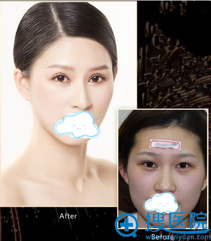 双眼皮前后对比图 双眼皮前后对比图